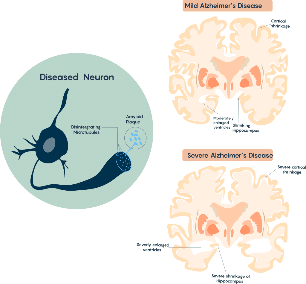 Characteristics and Progression of Alzheimer's Disease, 2.4 Chronic Neurodegenerative Diseases – Neuroscience: Canadian 1st Edition
