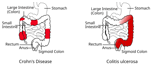 Crohn's vs ulcerative colitis, Crohn's disease - Wikipedia
