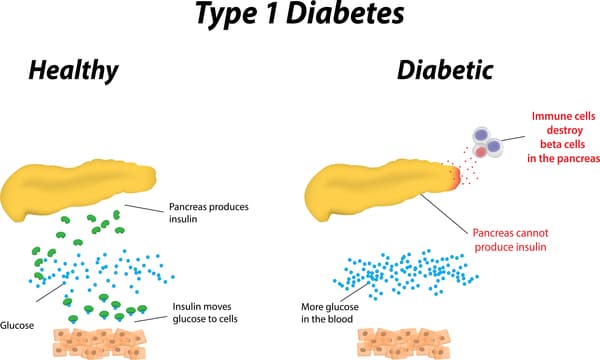 Etiology and Pathophysiology, Diabetes mellitus type 1 pathophysiology - wikidoc