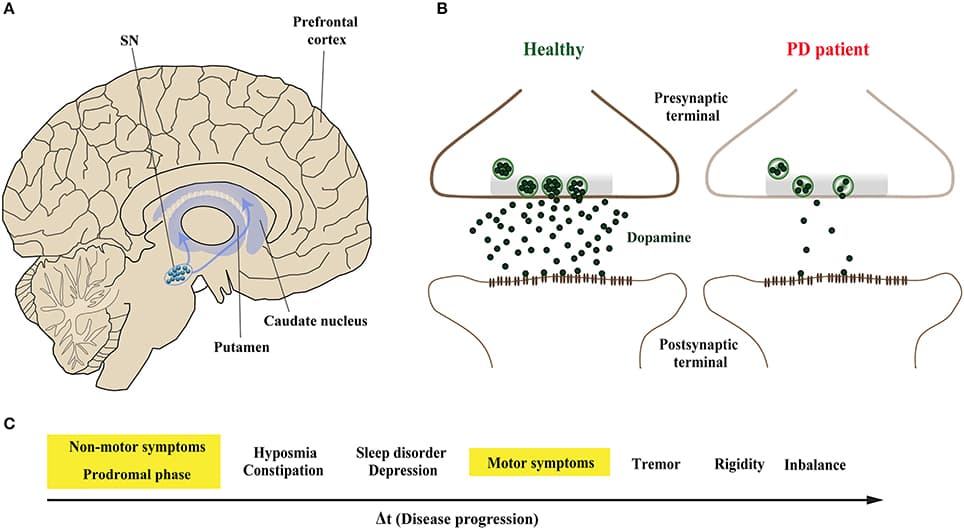 Mechanisms of Parkinson's disease, Frontiers | Mechanisms of α-Synuclein Induced Synaptopathy in Parkinson's Disease