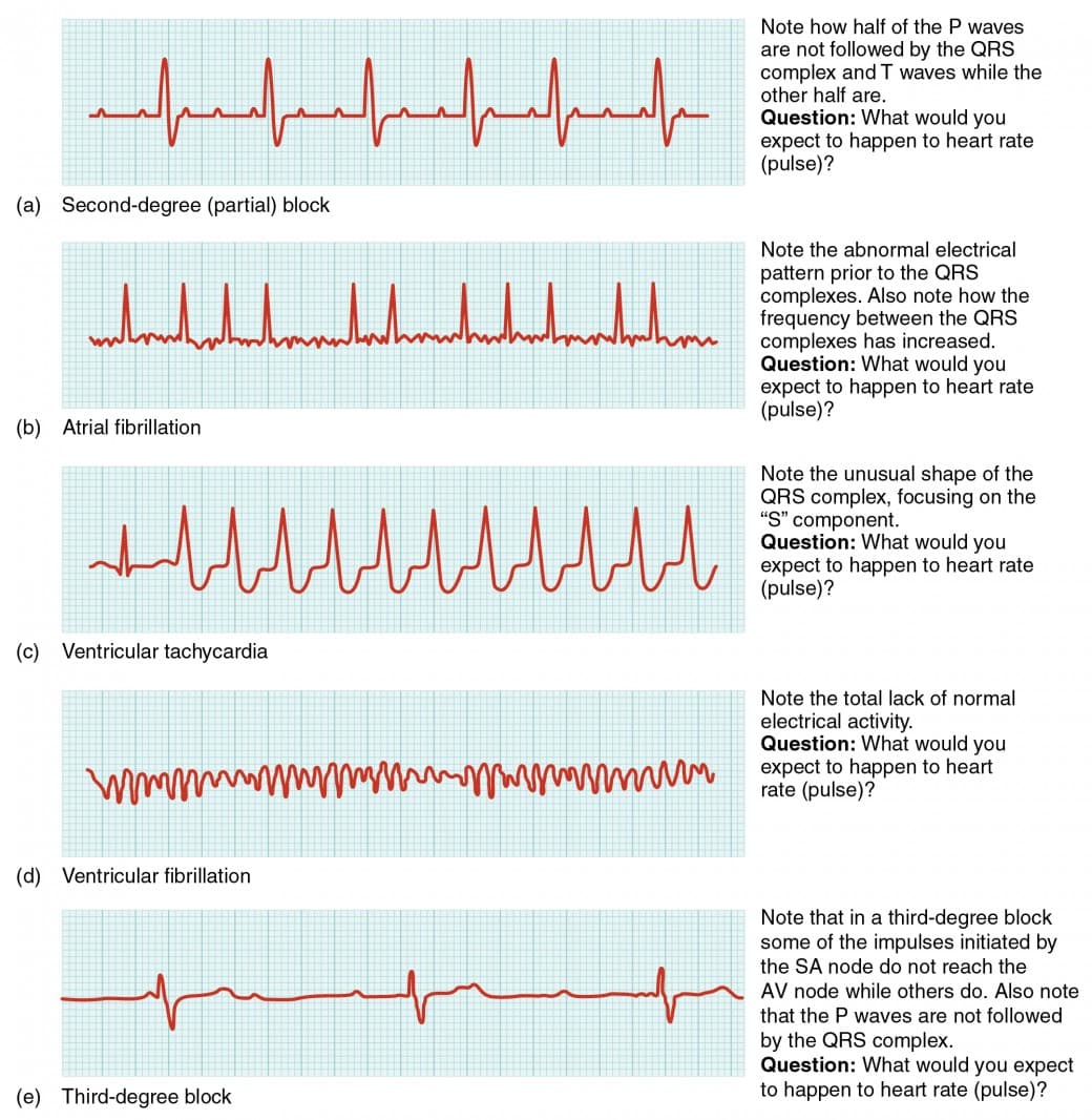 Mechanisms of cardiac arrhythmias, Cardiac Muscle and Electrical Activity | Anatomy and Physiology
