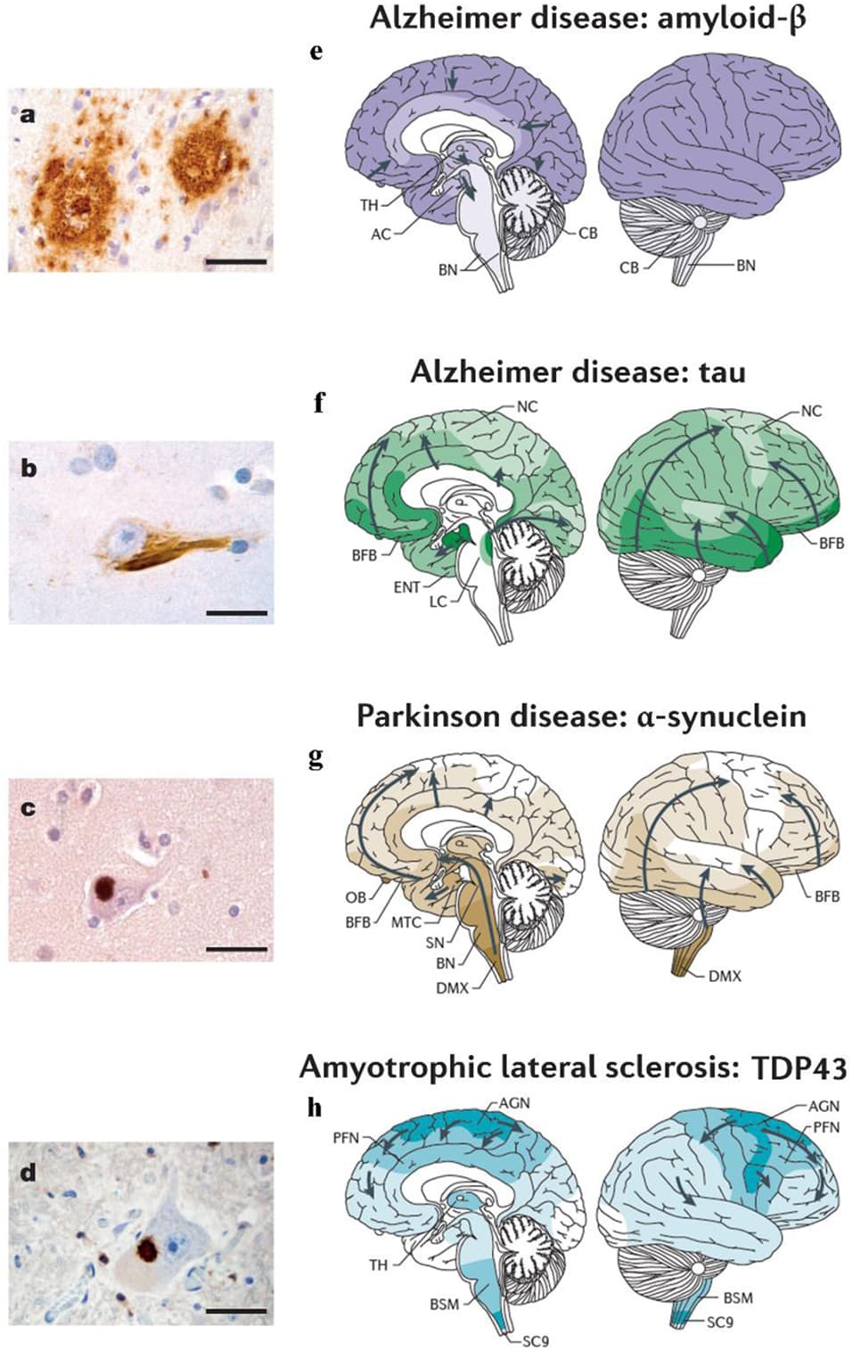 Neuropathology of neurocognitive disorders, Frontiers | Mathematical Modeling of Protein Misfolding Mechanisms in Neurological Diseases: A ...