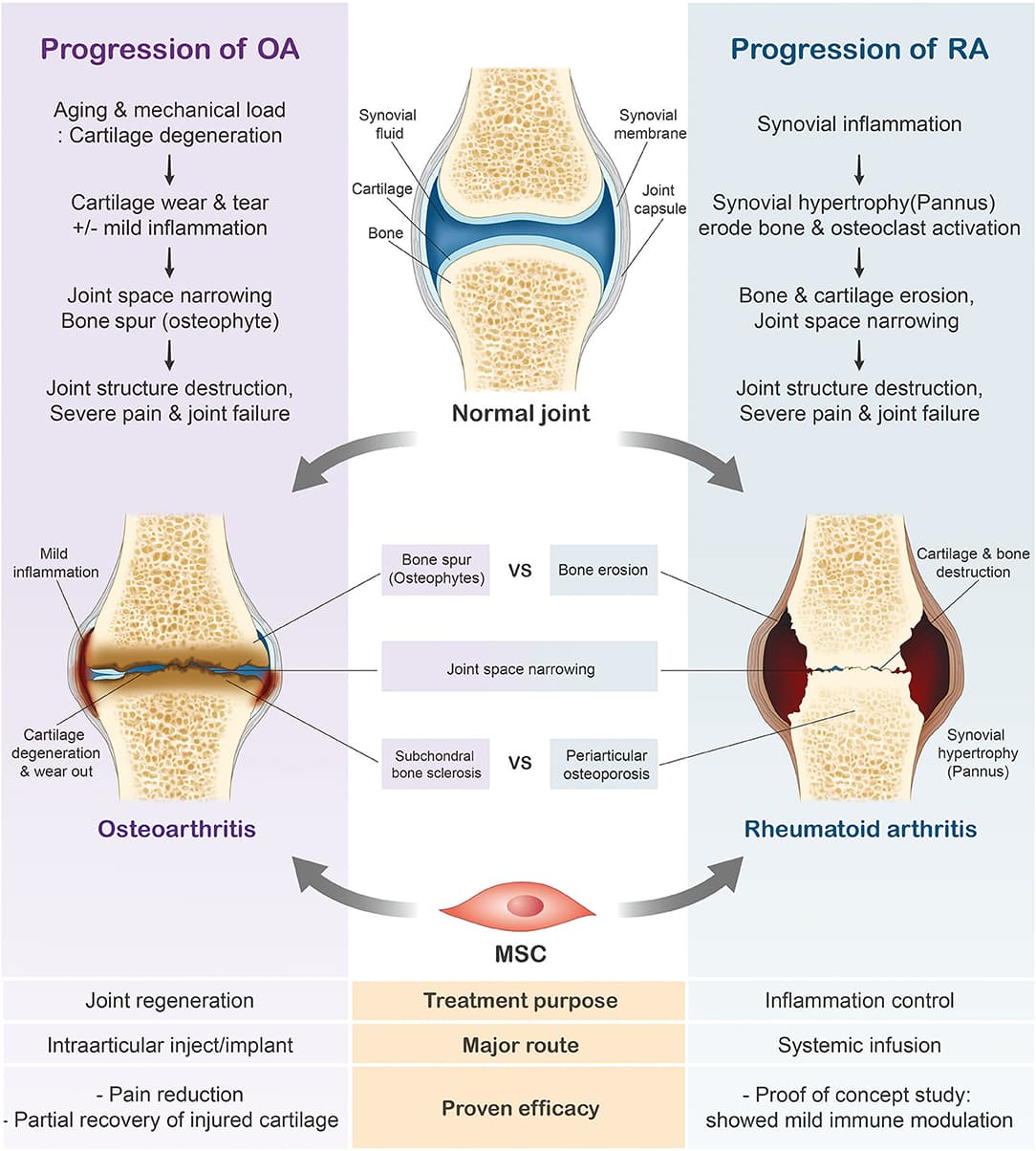 Osteoarthritis vs rheumatoid arthritis, Frontiers | Recent Developments in Clinical Applications of Mesenchymal Stem Cells in the ...