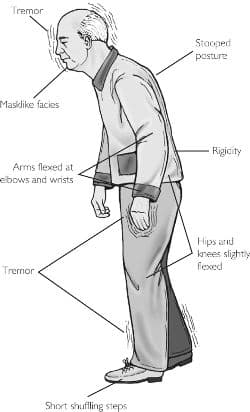 Motor Symptoms and Non-Motor Manifestations, Parkinsons Disease - Cell Biology - Cell Biology of Disease and Exercise