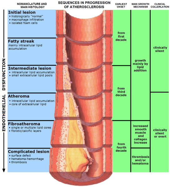 Pathophysiology of coronary artery disease, Diseases and Disorders of the Heart | Boundless Anatomy and Physiology