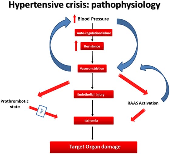 Pathophysiology of hypertension, Frontiers | Cardiovascular Hypertensive Crisis: Recent Evidence and Review of the Literature