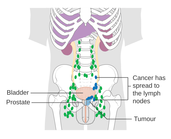 Pathophysiology of prostate disorders, File:Diagram showing prostate cancer that has spread to the lymph nodes CRUK 184.svg - Wikimedia ...