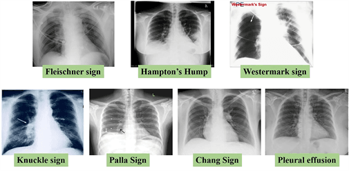Signs and risks of pulmonary conditions, Current Concepts in the Diagnosis and Management of Pulmonary Embolism