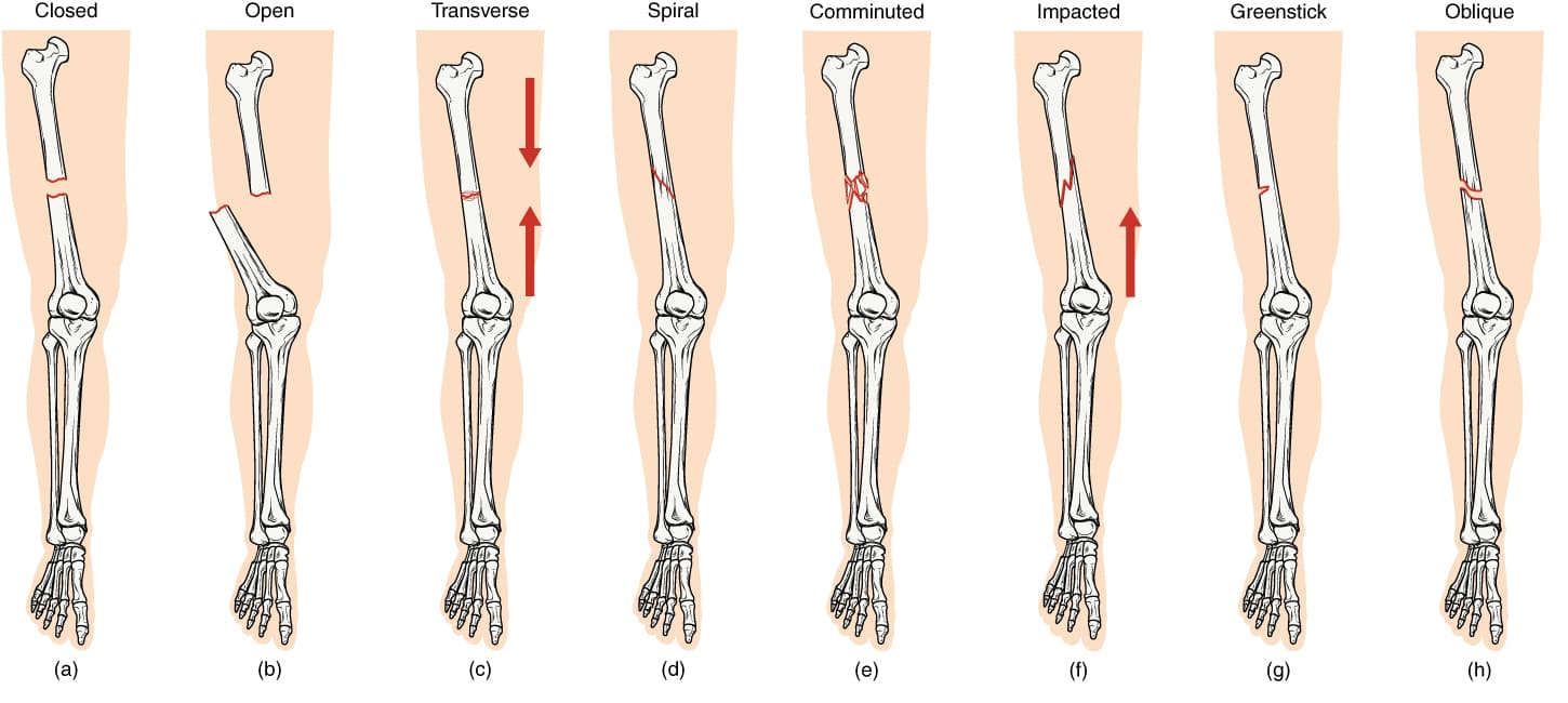 Types of bone fractures, Fractures: Bone Repair | Anatomy and Physiology I