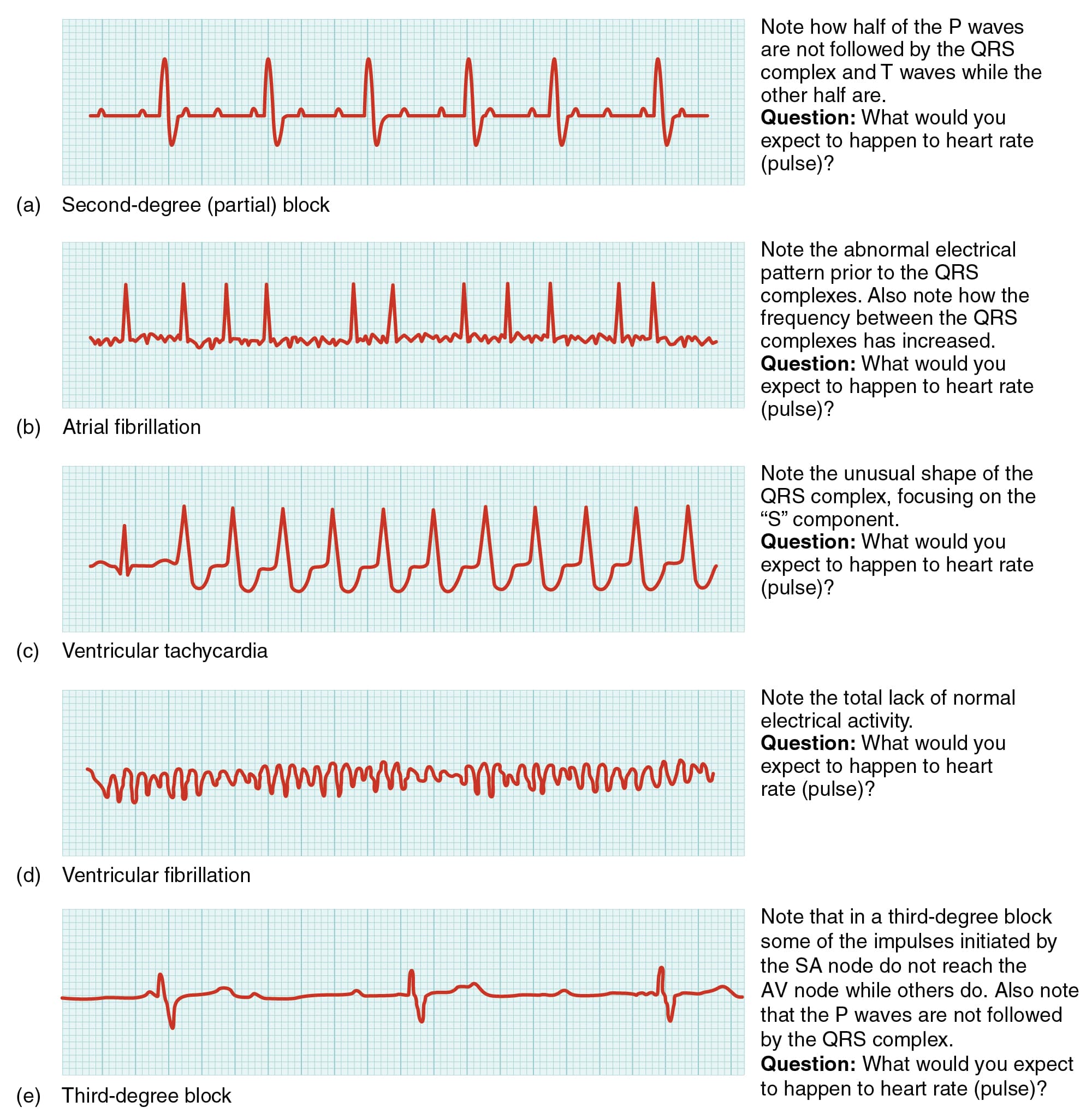 Types of cardiac dysrhythmias, Cardiovascular System – Heart – Building a Medical Terminology Foundation