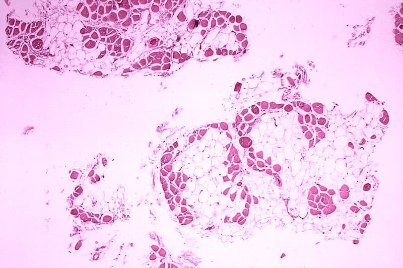 Types of muscular dystrophies, Duchenne muscular dystrophy pathophysiology - wikidoc