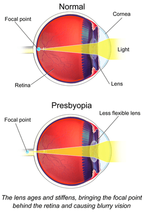 Vision and Hearing Impairments, Presbyopia - Wikipedia